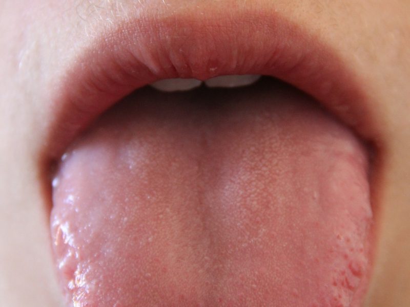 Mouth Ulcer